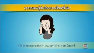 Health Me Please | โรคปากเบี้ยวครึ่งซีก ตอน 3 | 25-01-60 | TV3 Official