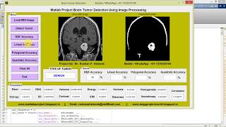Matlab Project Brain Tumor Detection Using Image Processing Full Source Code || IEEE Based Project