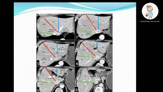 Cách đọc Giải phẫu Gan trên CLVT