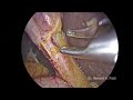 3 PORT LAP CHOLECYSTECTOMY (REDUCED PORT SURGERY)