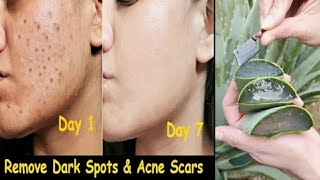 Get Clear, Spotless Skin With Aloevera| ఇది రాస్తే 7 రోజుల్లో ముఖంపై మొటిమలు, మచ్చలు పోయి తెల్లగా...