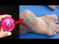 Remove Cracked Heels and Get Beautiful Feet Permanently - Magical Cracked Heels Home Remedy
