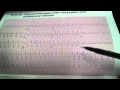 EKG ECG electrocardiogram Cardiologist Cardiology www.drbenzur.com