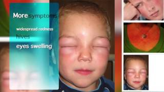MCPS Anaphylaxis Training Video