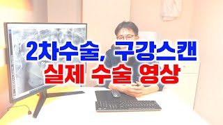 2차수술 구강 스캔 실제 수술 영상