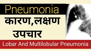 निमोनिया के लक्षण कारण व उपचार  Pneumonia Symptoms  Pneumonia Types Lobar Or Lobular Pneumonia