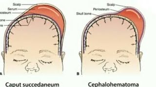 Cephalohematoma Vs Caput Succedaneum