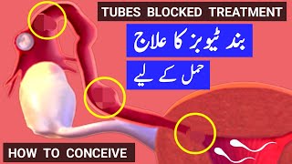 Tubes Blocked Treatment |How To Conceive Pregnancy With Blocked Fallopian Tubes |Band Tubes ka ilaj