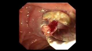 Pancreatic stone extraction endoscopically Pancreatic stone extraction endoscopically