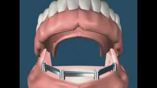 Prótese Total Sobre Implantes com Barra Clip - Tripla