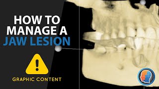 How to manage a jaw lesion