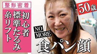 【糸リフト整形密着】50代ママのはじめて糸リフト10本➡シワ・たるみを上げた結果【ヒアルロン酸併用】湘南美容クリニック