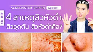 4 สาเหตุของสิวหัวดำ สิวอุดตัน สิวหัวดำคืออะไร ? l AcneTalk