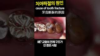 치아파절의 원인. 쇼03 DentiTube20230926