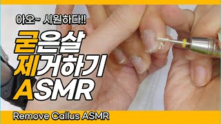 손굳은살제거 ASMR removeCallus