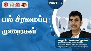 பல் சீரமைப்பு முறைகள்!!! | Part 4