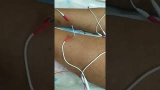 Acupuncture treatment for knee pain, no operation no injection in ahmedabad 9099200173