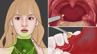 ASMR Get Rid of Bad Breath! Tonsil Stone Removal, Salivary Glands Cleaning | Meng's Stop Motion