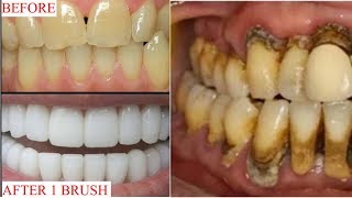 सिर्फ 1 मिनट में पीले गंदे दांतों को मोती जैसा चमका देगा यह जबरदस्त नुस्खा//TEETH WHITENING