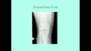 Osteoarthritis - CRASH! Medical Review Series