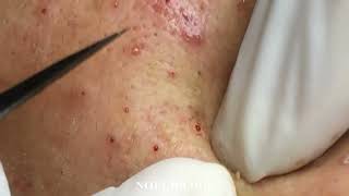 Popping Tons Of Blackheads Part 176