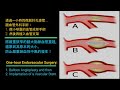 嚴重左側ica腦大動脈血管狹窄症 severe left ica cerebral stenosis