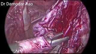 Allen Masters pocket excision with Chocolate cyst excision by Dr Damodar Rao