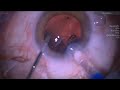 cataract surgery in psc posterior subcapsular cataract