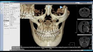3D Ceph Superimpose