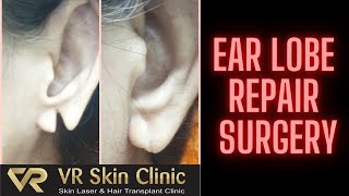 Ear Lobe Repair Surgery| कान के छेद की सिलाई  | VR Skin Clinic |Dr Rekha | Dr Vineet