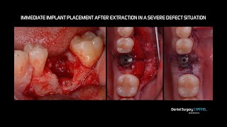 SURGICAL TIPS FOR SAFE FULL/PARTIAL THICKNESS FLAP DEBRIDEMENT IN A THIN AND PRE-DAMAGED FLAP: