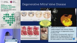 Θ. Ζαγκλαβάρα  | Υπερηχογραφική μελέτη στην ανεπάρκεια της μιτροειδούς