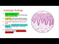 oral lichen planus part 2 oral manifestations histopathology diagnosis u0026 treatment