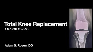 One Month Post-Op Total Knee Replacement - Expectations, common findings and physical therapy