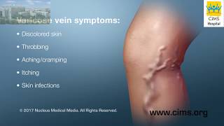 Treatment for Varicose Veins Procedures (Gujarati) - CIMS Hospital