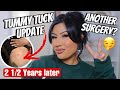 TUMMY TUCK UPDATE!! *2 1/2 YEARS POST OP SCAR REVEAL* ALMA RIVERA