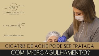 Cicatriz de acne pode ser tratada com microagulhamento?