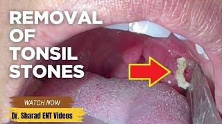 Tonsil Stones Removal Up Close: Watch So Many Of Them All Come Out! || Must-See Extraction Process!🤯