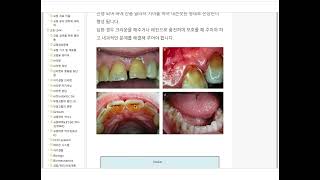 역류성 식도염과 치아 손상