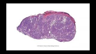 Adnexal neoplasms