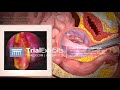 3D Animation of Hysteroscopy - Polypectomy Procedure