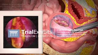 3D Animation of Hysteroscopy - Polypectomy Procedure