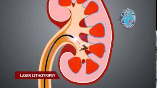 Retrograde Intrarenal Surgery - RIRS