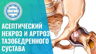 👉 Асептический некроз головки бедренной кости и артроз тазобедренного сустава