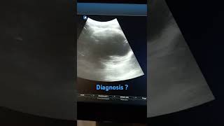 Obs scan of 32 yrs G2P1 women @ 36WOG..Diagnosis??