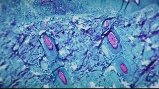 CDC activates emergency operations center in response to monkeypox
