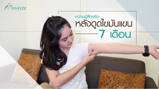 หลังดูดไขมันแขน 7 เดือนกับ Issavee clinic