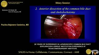 26 years of experience in laparoscopic common bile duct exploration