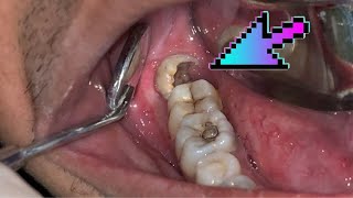 Wisdom Tooth | Third Molar | Geraham Bungsu | Dentist | Dokter Gigi Tri Putra