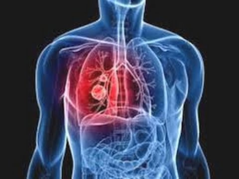 blood clot in lung symptoms blood clot in lung symptoms